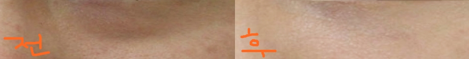 닥터유코크 눈밑지 했습니다! 진작할껄 그랬어요 ㅠ